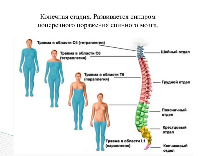 Конечная стадия. Развивается синдром поперечного поражения спинного мозга.