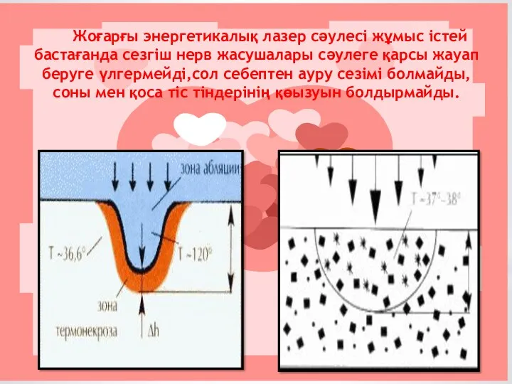 Жоғарғы энергетикалық лазер сәулесі жұмыс істей бастағанда сезгіш нерв жасушалары