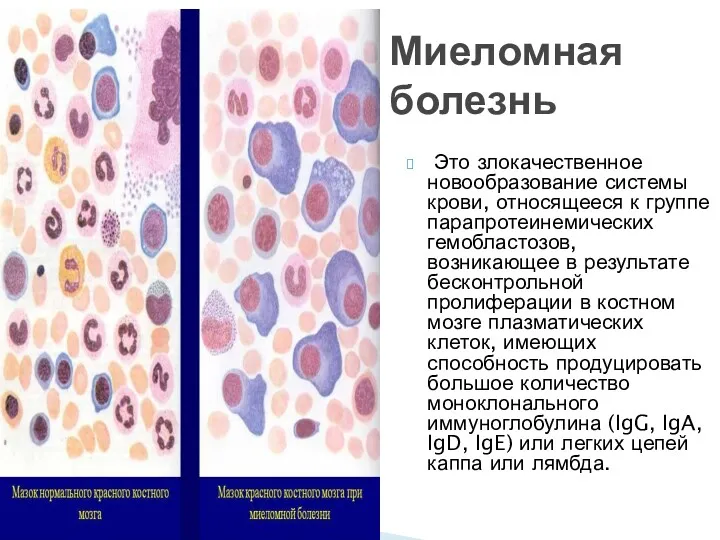 Это злокачественное новообразование системы крови, относящееся к группе парапротеинемических гемобластозов,