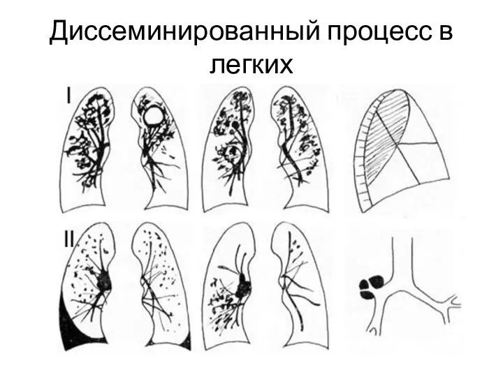 Диссеминированный процесс в легких