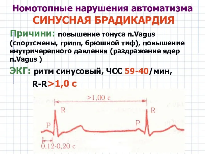 Номотопные нарушения автоматизма СИНУСНАЯ БРАДИКАРДИЯ Причини: повышение тонуса n.Vagus (спортсмены,