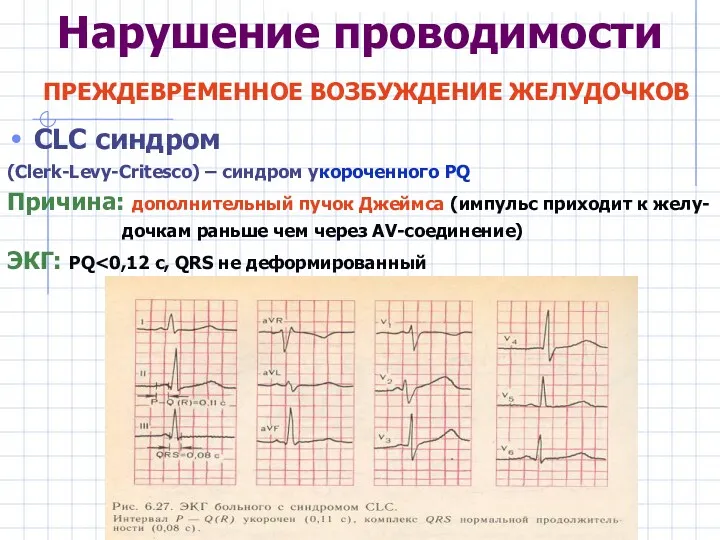 Нарушение проводимости ПРЕЖДЕВРЕМЕННОЕ ВОЗБУЖДЕНИЕ ЖЕЛУДОЧКОВ CLC синдром (Clerk-Levy-Critesco) – синдром