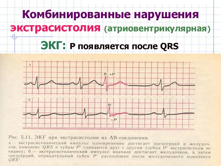 Комбинированные нарушения экстрасистолия (атриовентрикулярная) ЭКГ: Р появляется после QRS