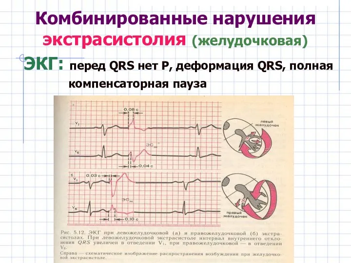 Комбинированные нарушения экстрасистолия (желудочковая) ЭКГ: перед QRS нет Р, деформация QRS, полная компенсаторная пауза