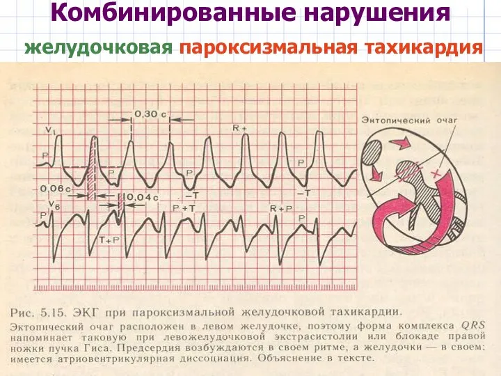 Комбинированные нарушения желудочковая пароксизмальная тахикардия