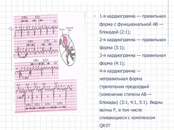 1-я кардиограмма — правильная форма с функциональной АВ — блока­дой