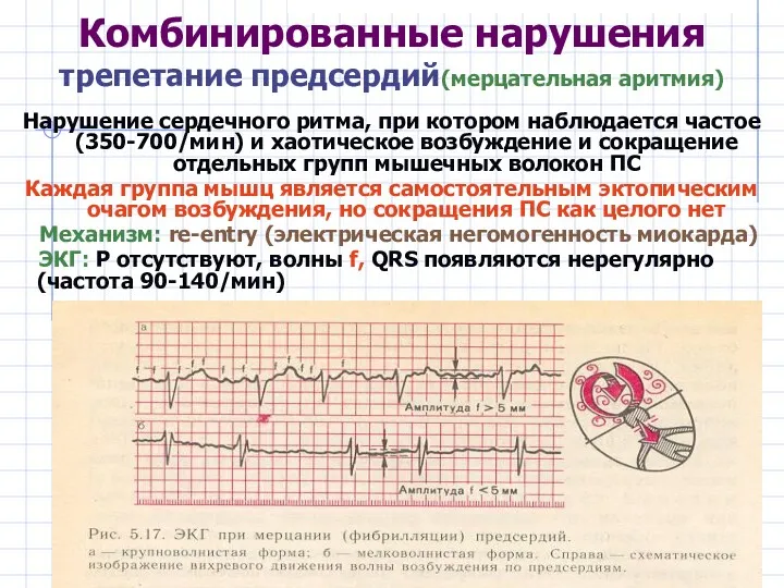 Комбинированные нарушения трепетание предсердий(мерцательная аритмия) Нарушение сердечного ритма, при котором