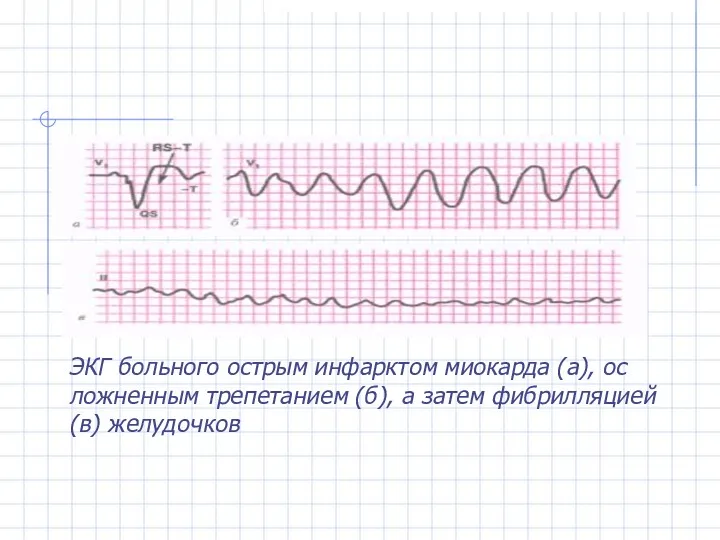 ЭКГ больного острым инфарктом миокарда (а), ос­ложненным трепетанием (б), а затем фибрилляцией (в) желудочков