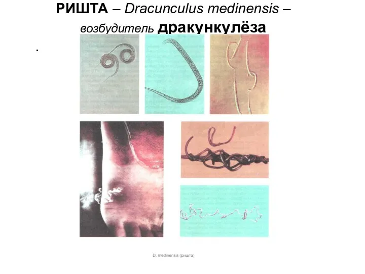РИШТА – Dracunculus medinensis – возбудитель дракункулёза .