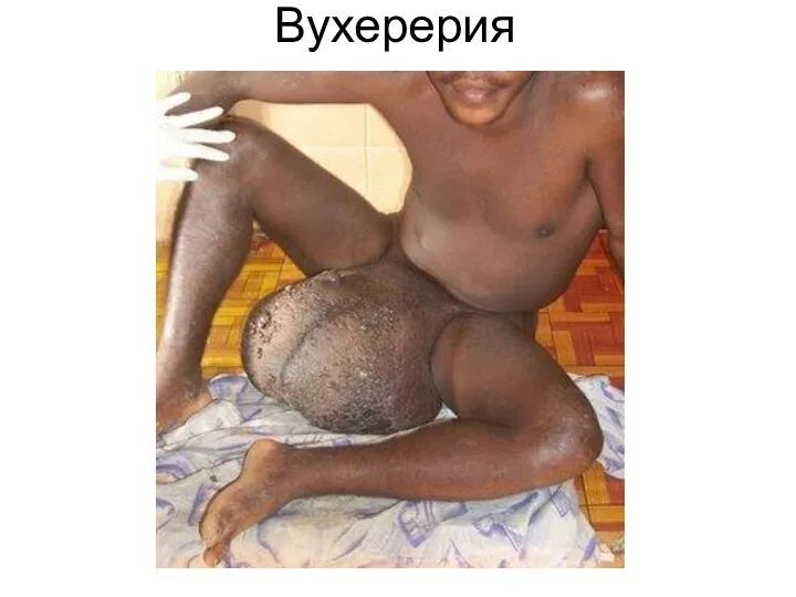 Вухерерия