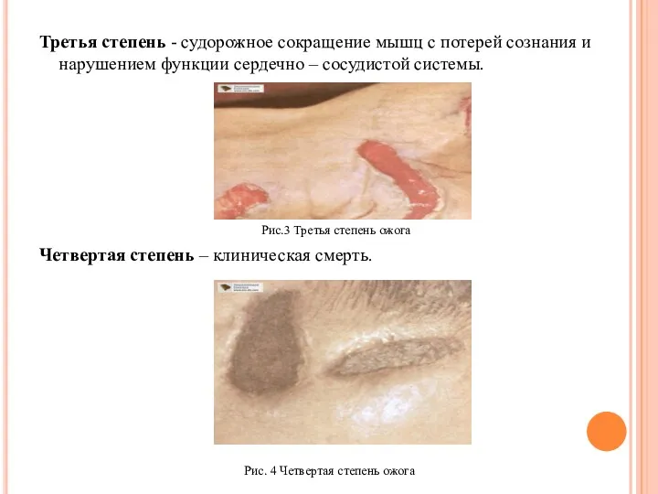 Третья степень - судорожное сокращение мышц с потерей сознания и