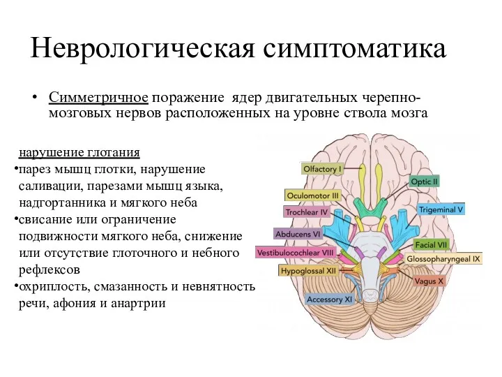 Неврологическая симптоматика Симметричное поражение ядер двигательных черепно-мозговых нервов расположенных на уровне ствола мозга