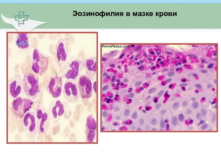 Эозинофилия в мазке крови
