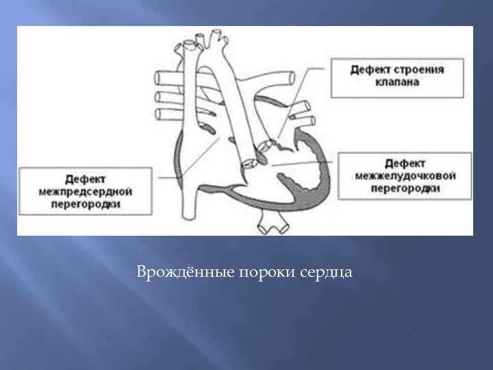 Врождённые пороки сердца