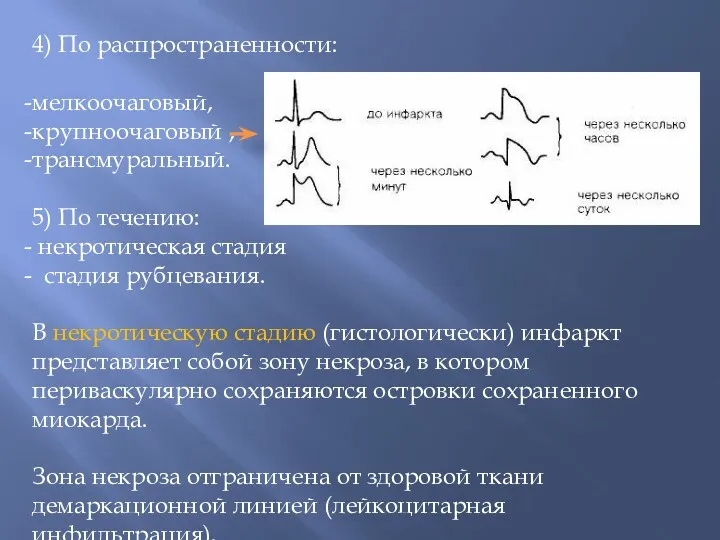 4) По распространенности: мелкоочаговый, крупноочаговый , трансмуральный. 5) По течению: