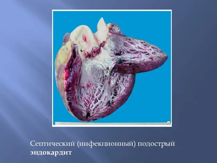 Септический (инфекционный) подострый эндокардит