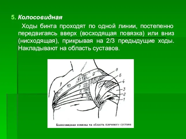 5. Колосовидная Ходы бинта проходят по одной линии, постепенно передвигаясь