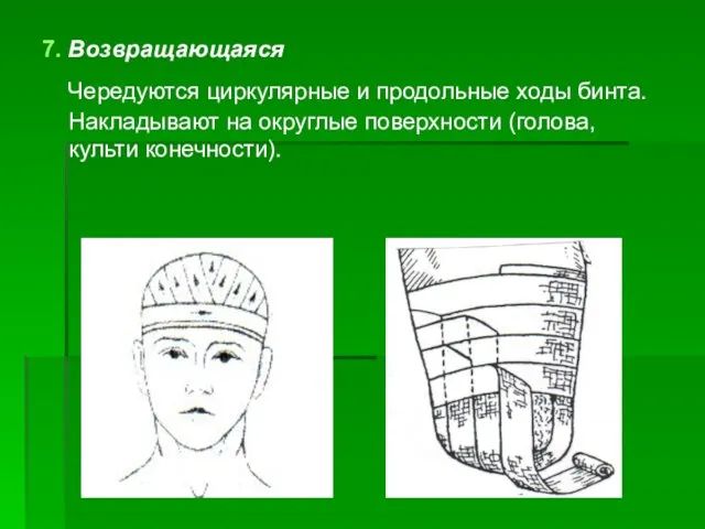 7. Возвращающаяся Чередуются циркулярные и продольные ходы бинта. Накладывают на округлые поверхности (голова, культи конечности).