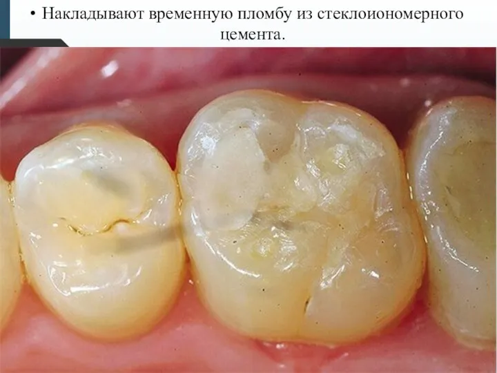 Накладывают временную пломбу из стеклоиономерного цемента.