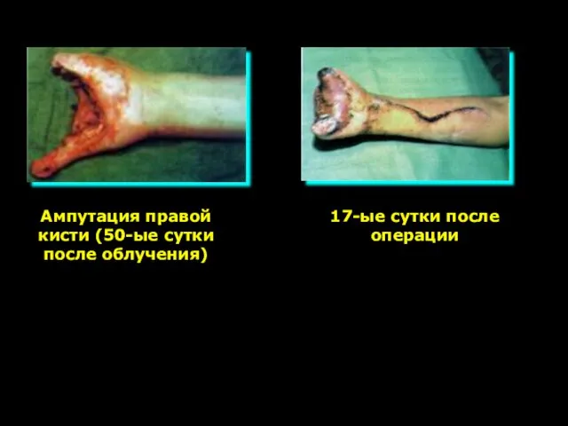 Ампутация правой кисти (50-ые сутки после облучения) 17-ые сутки после операции