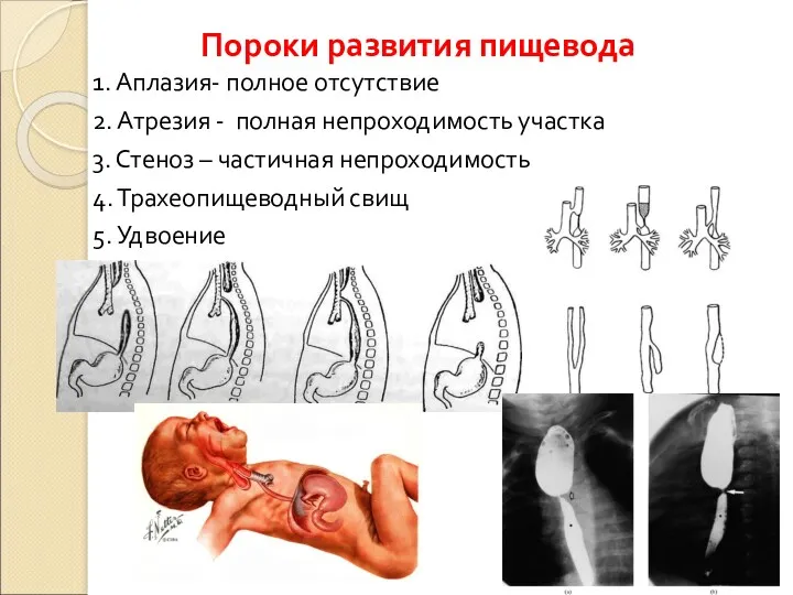 1. Аплазия- полное отсутствие 2. Атрезия - полная непроходимость участка