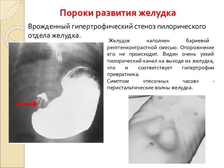 Врожденный гипертрофический стеноз пилорического отдела желудка. Желудок наполнен бариевой рентгенконтрастной