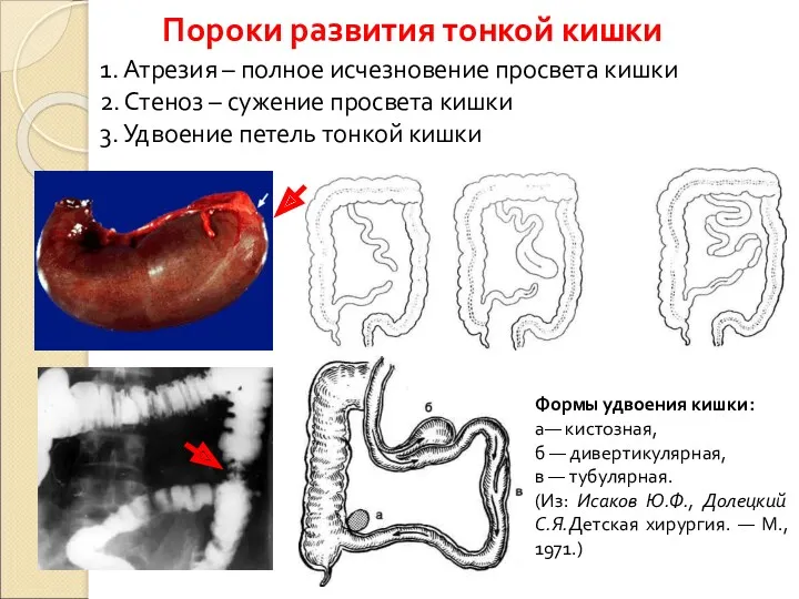 Пороки развития тонкой кишки 1. Атрезия – полное исчезновение просвета