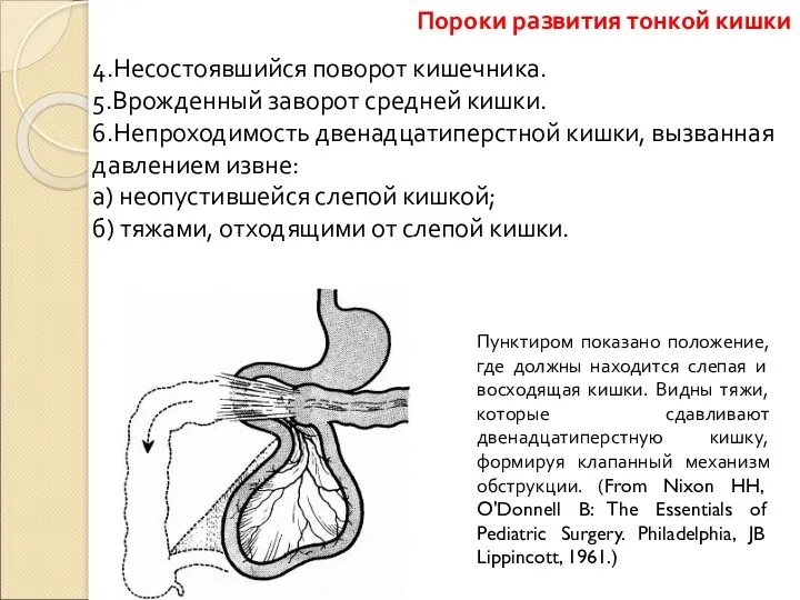 4.Несостоявшийся поворот кишечника. 5.Врожденный заворот средней кишки. 6.Непроходимость двенадцатиперстной кишки,