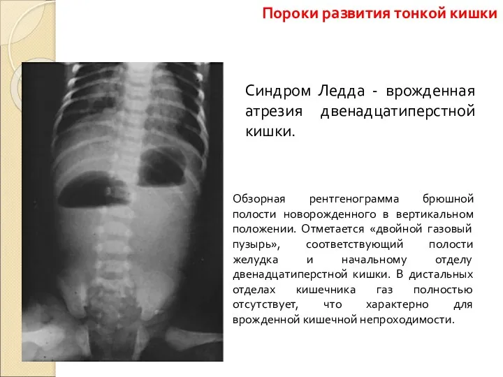 Синдром Ледда - врожденная атрезия двенадцатиперстной кишки. Обзорная рентгенограмма брюшной