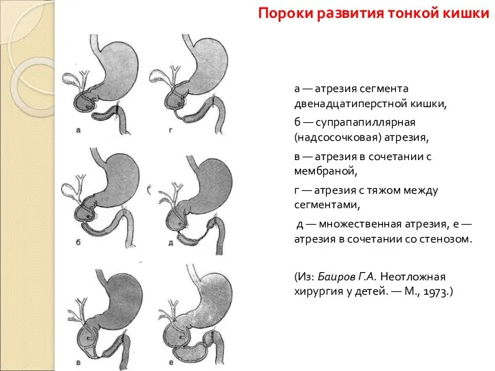 а — атрезия сегмента двенадцатиперстной кишки, б — супрапапиллярная (надсосочковая)