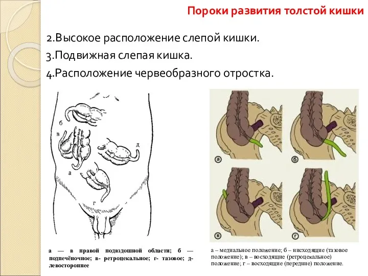 2.Высокое расположение слепой кишки. 3.Подвижная слепая кишка. 4.Расположение червеобразного отростка.