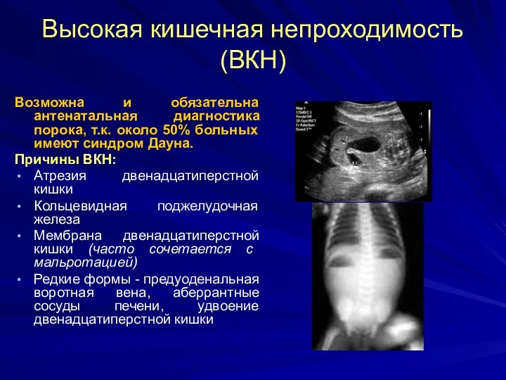 Высокая кишечная непроходимость (ВКН) Возможна и обязательна антенатальная диагностика порока,