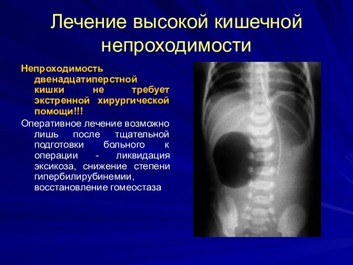 Лечение высокой кишечной непроходимости Непроходимость двенадцатиперстной кишки не требует экстренной