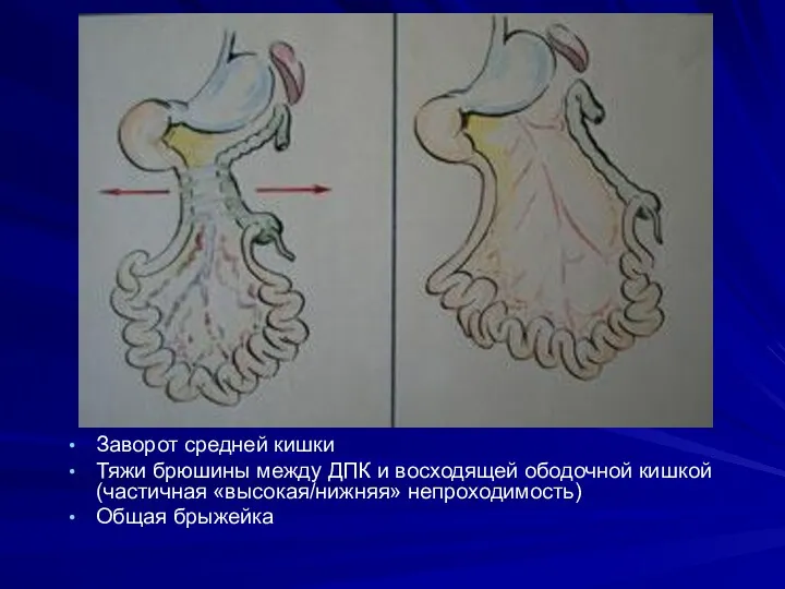 Заворот средней кишки Тяжи брюшины между ДПК и восходящей ободочной кишкой (частичная «высокая/нижняя» непроходимость) Общая брыжейка