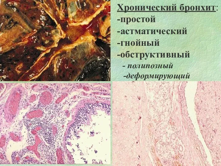 Хронический бронхит: -простой -астматический -гнойный -обструктивный - полипозный -деформирующий