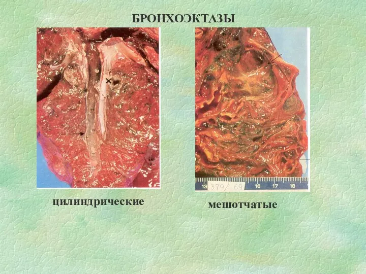 БРОНХОЭКТАЗЫ цилиндрические мешотчатые