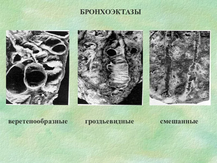 БРОНХОЭКТАЗЫ веретенообразные гроздьевидные смешанные