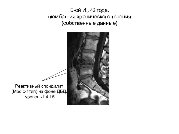 Б-ой И., 43 года, люмбалгия хронического течения (собственные данные) Реактивный