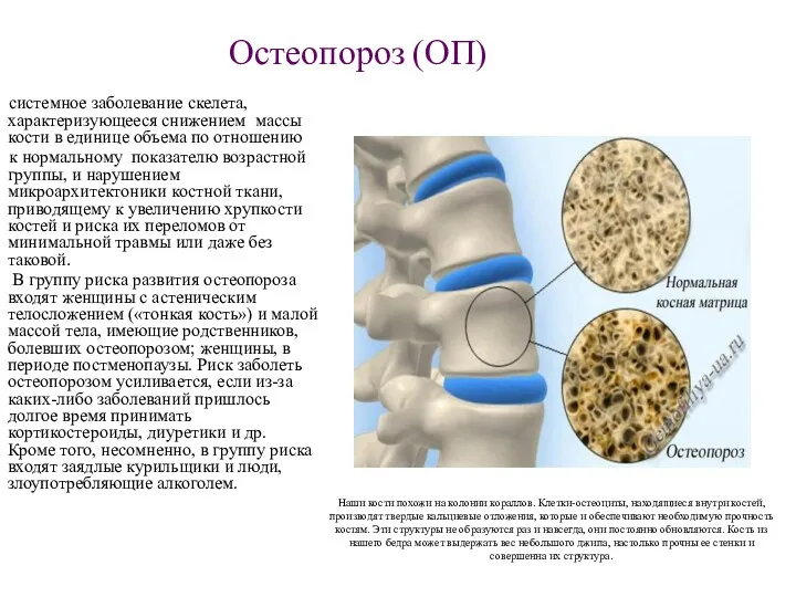 Остеопороз (ОП) системное заболевание скелета, характеризующееся снижением массы кости в