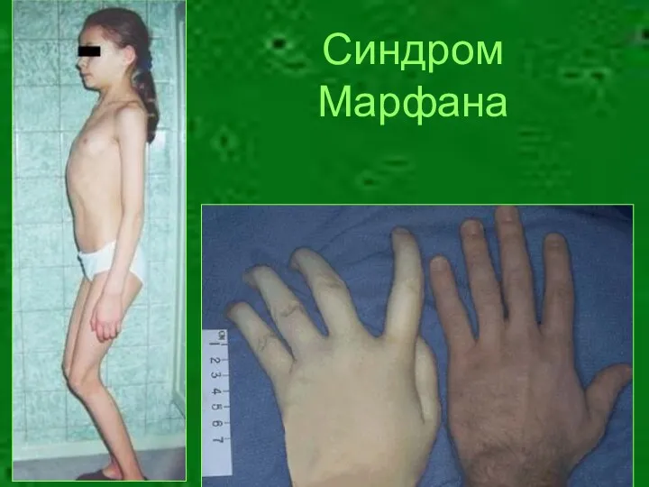 Синдром Марфана