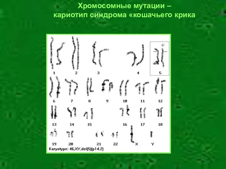 Хромосомные мутации – кариотип синдрома «кошачьего крика