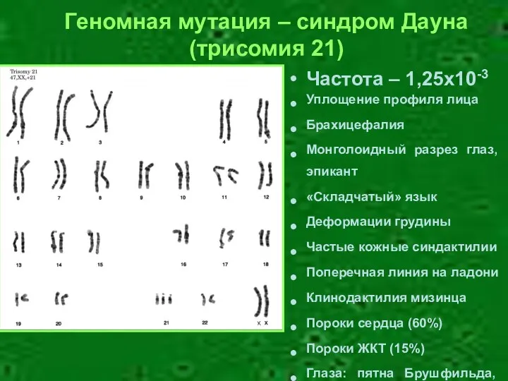 Геномная мутация – синдром Дауна (трисомия 21) Частота – 1,25х10-3