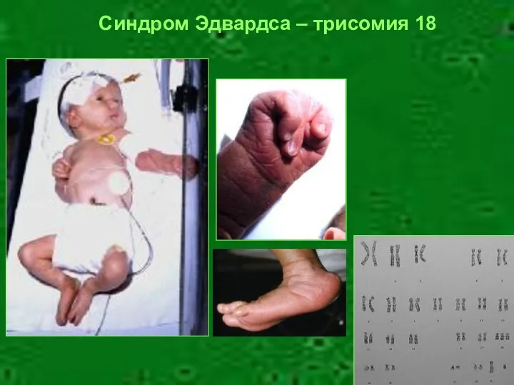 Синдром Эдвардса – трисомия 18