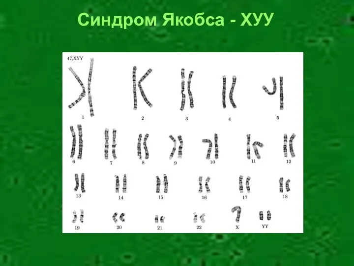 Синдром Якобса - ХУУ