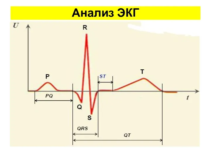 Анализ ЭКГ