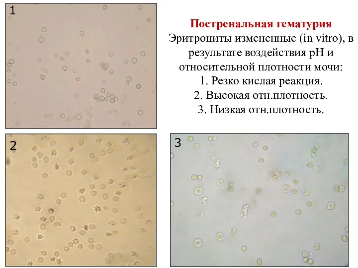 1 2 3 Постренальная гематурия Эритроциты измененные (in vitro), в