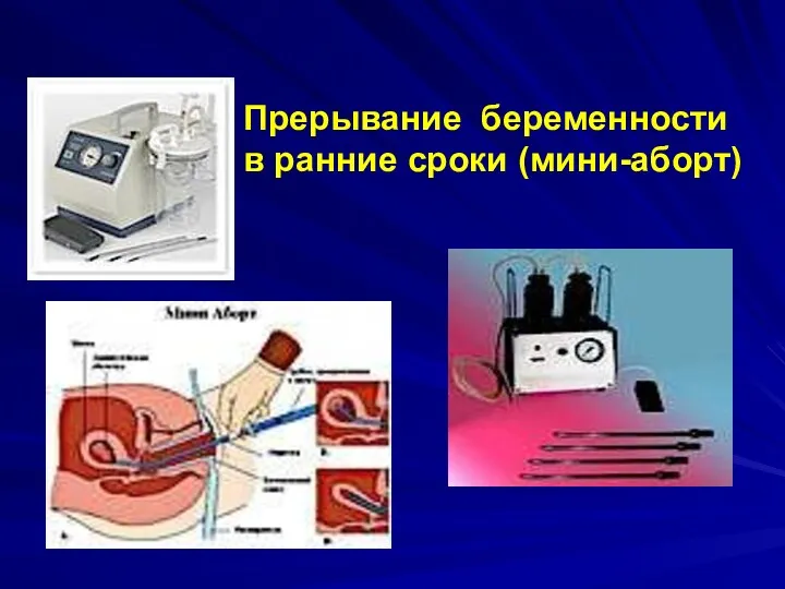 Прерывание беременности в ранние сроки (мини-аборт)