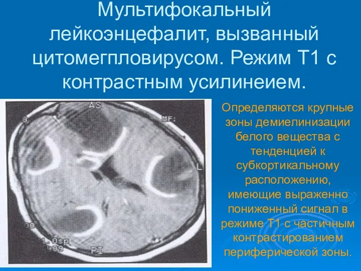 Мультифокальный лейкоэнцефалит, вызванный цитомегпловирусом. Режим Т1 с контрастным усилинеием. Определяются