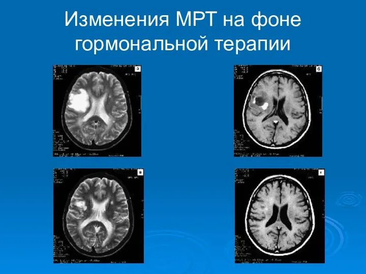 Изменения МРТ на фоне гормональной терапии