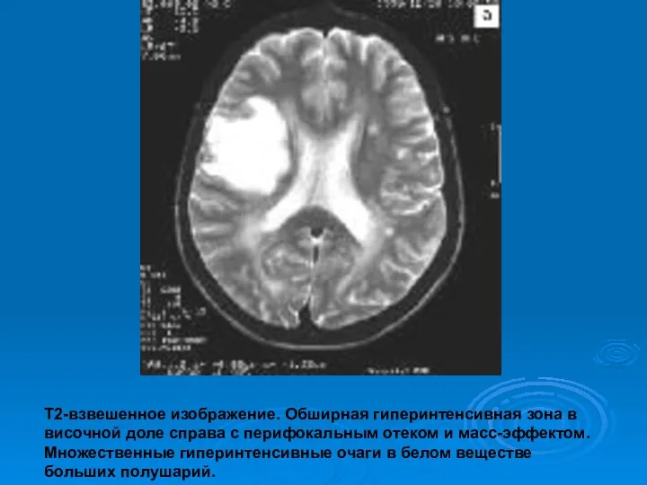 Т2-взвешенное изображение. Обширная гиперинтенсивная зона в височной доле справа с